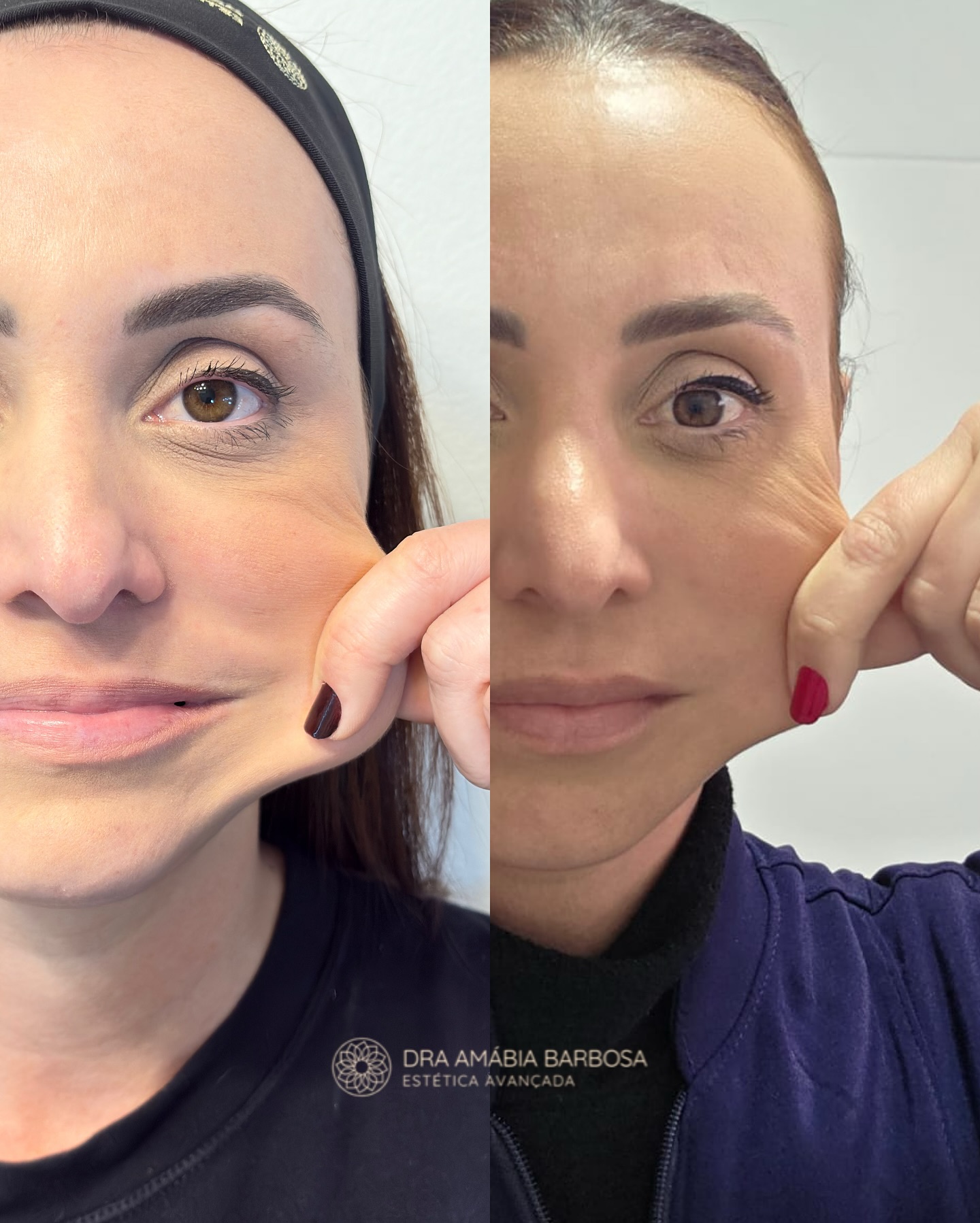 Antes e depois — bioestimulador de colágeno