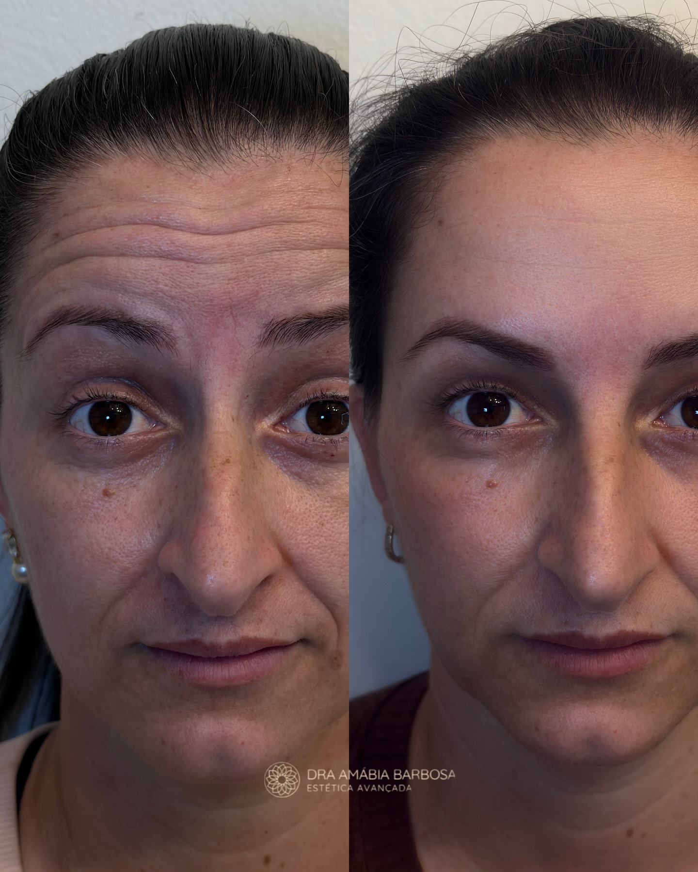 Antes e depois — toxina botulínica