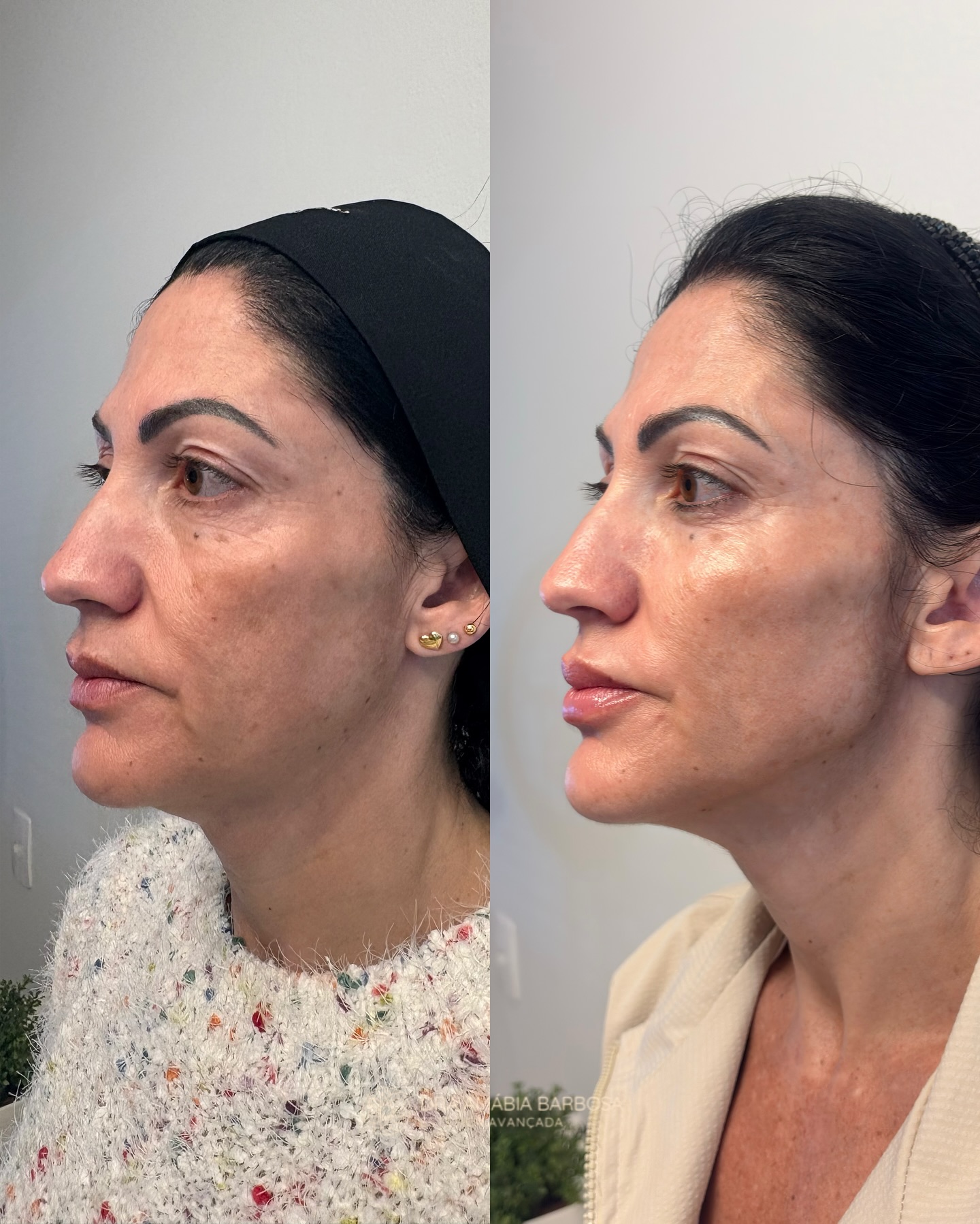 Antes e depois — harmonização facial