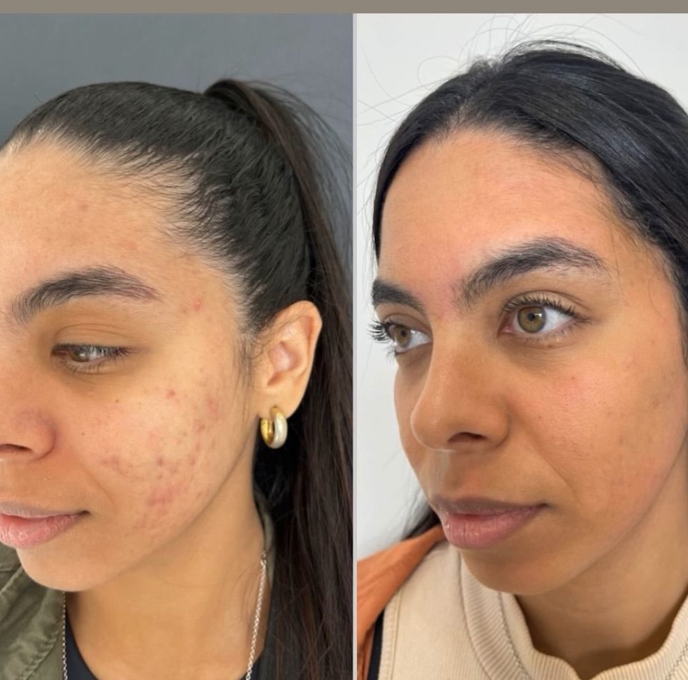 Antes e depois — tratamento Lavieen para a pele