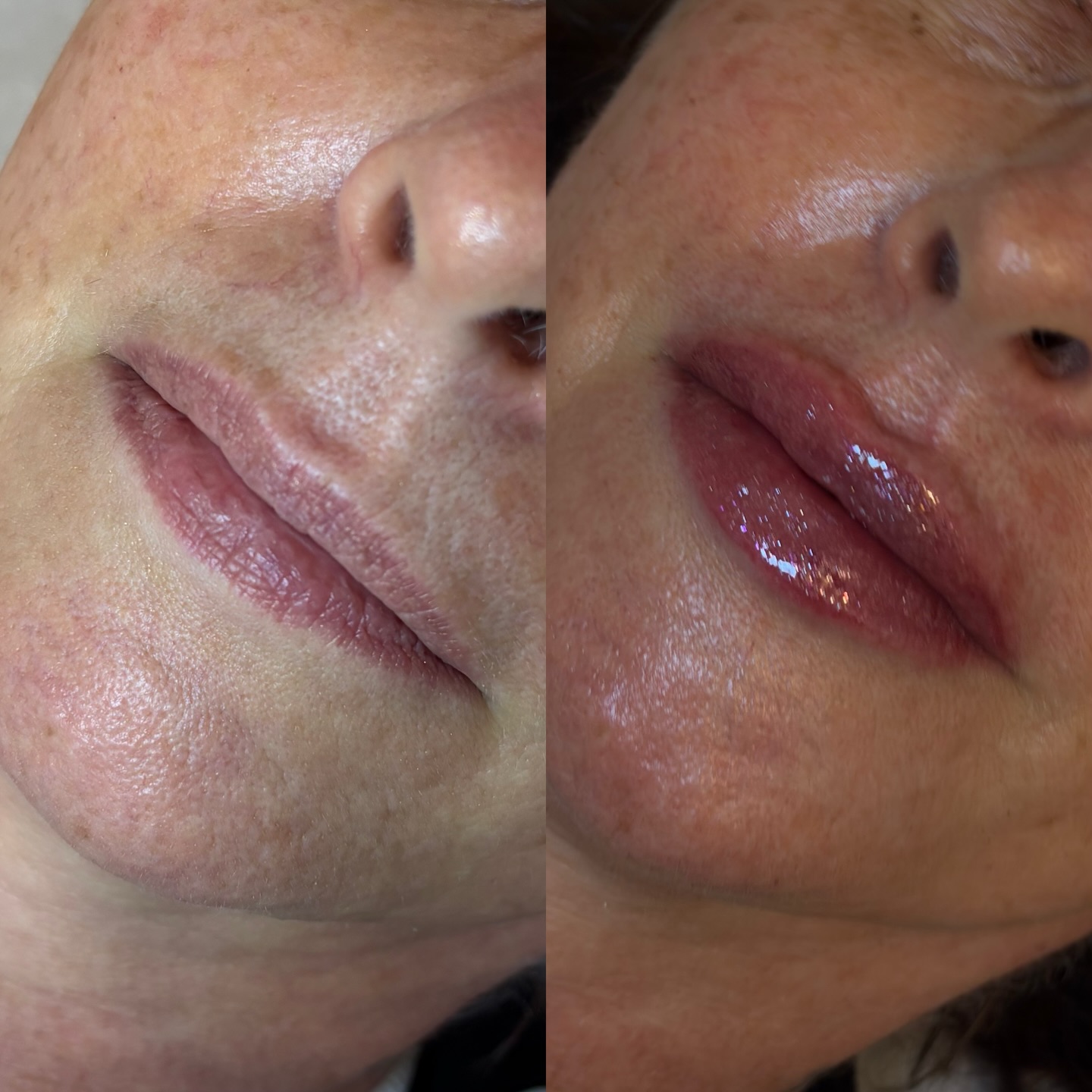 Antes e depois — preenchimento labial