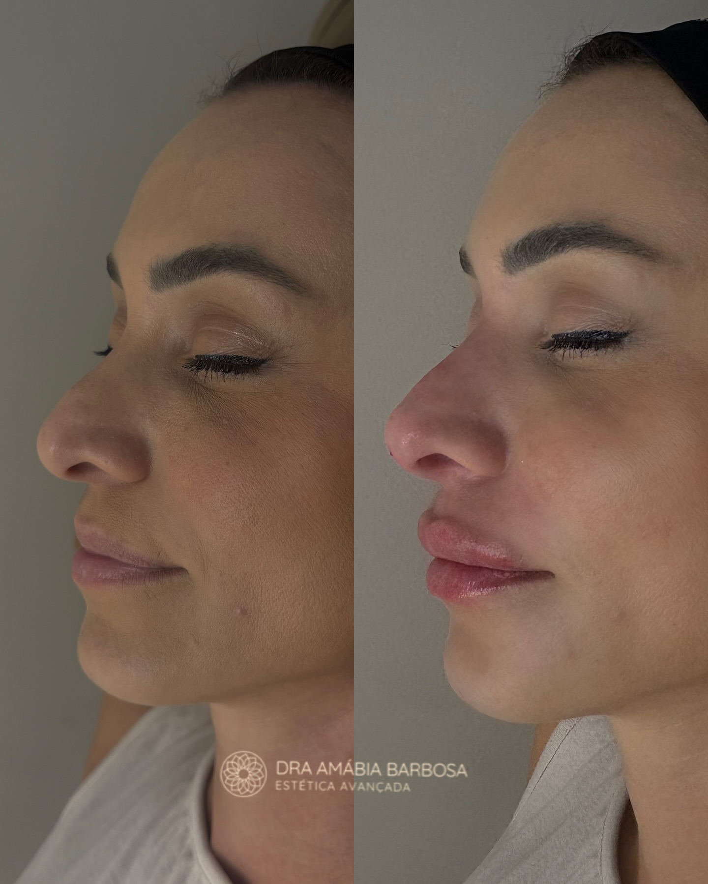 Resultado antes e depois — perfil