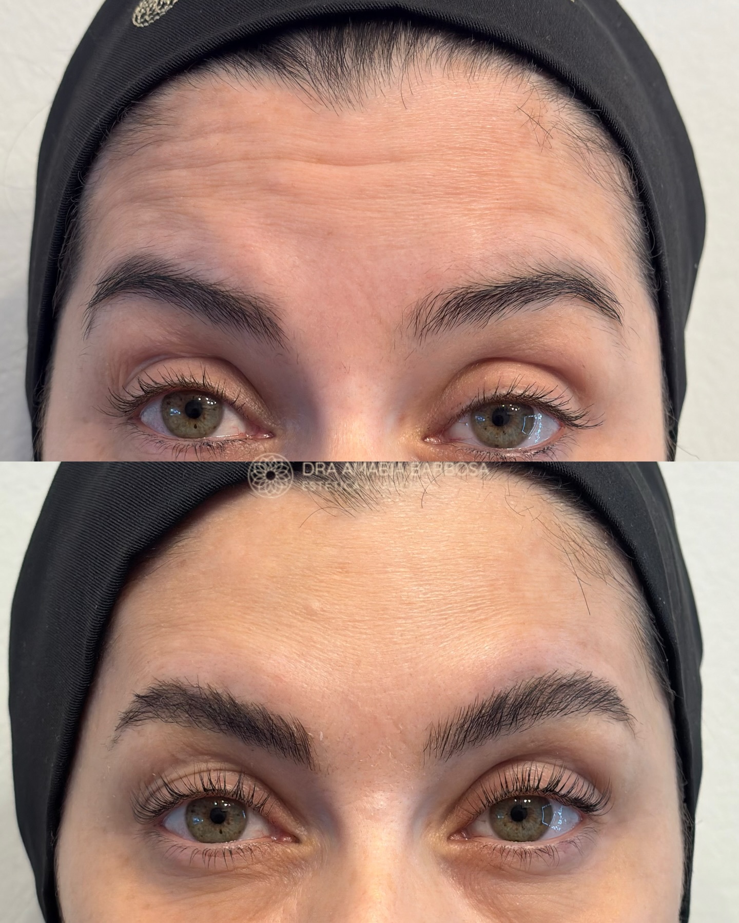 Resultado antes e depois — testa